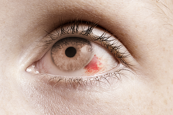 Know more about other Eye Diseases