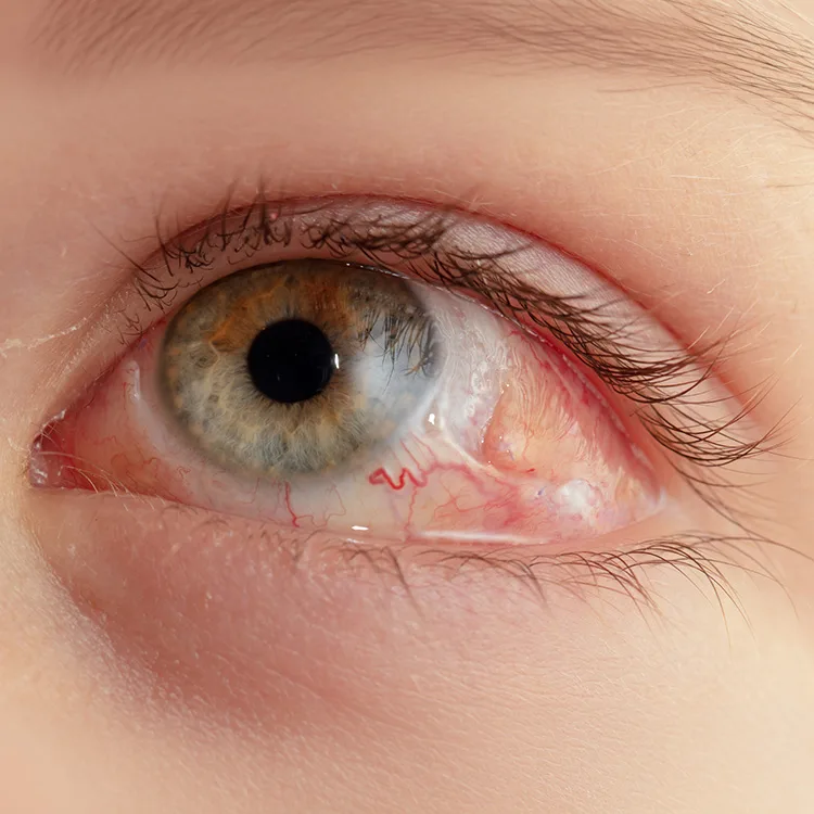 Retinal Detachment