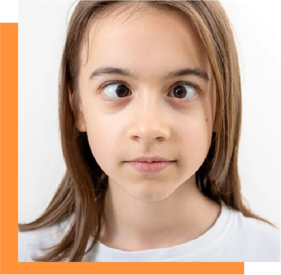 Squint Eye Treatment in Chennai