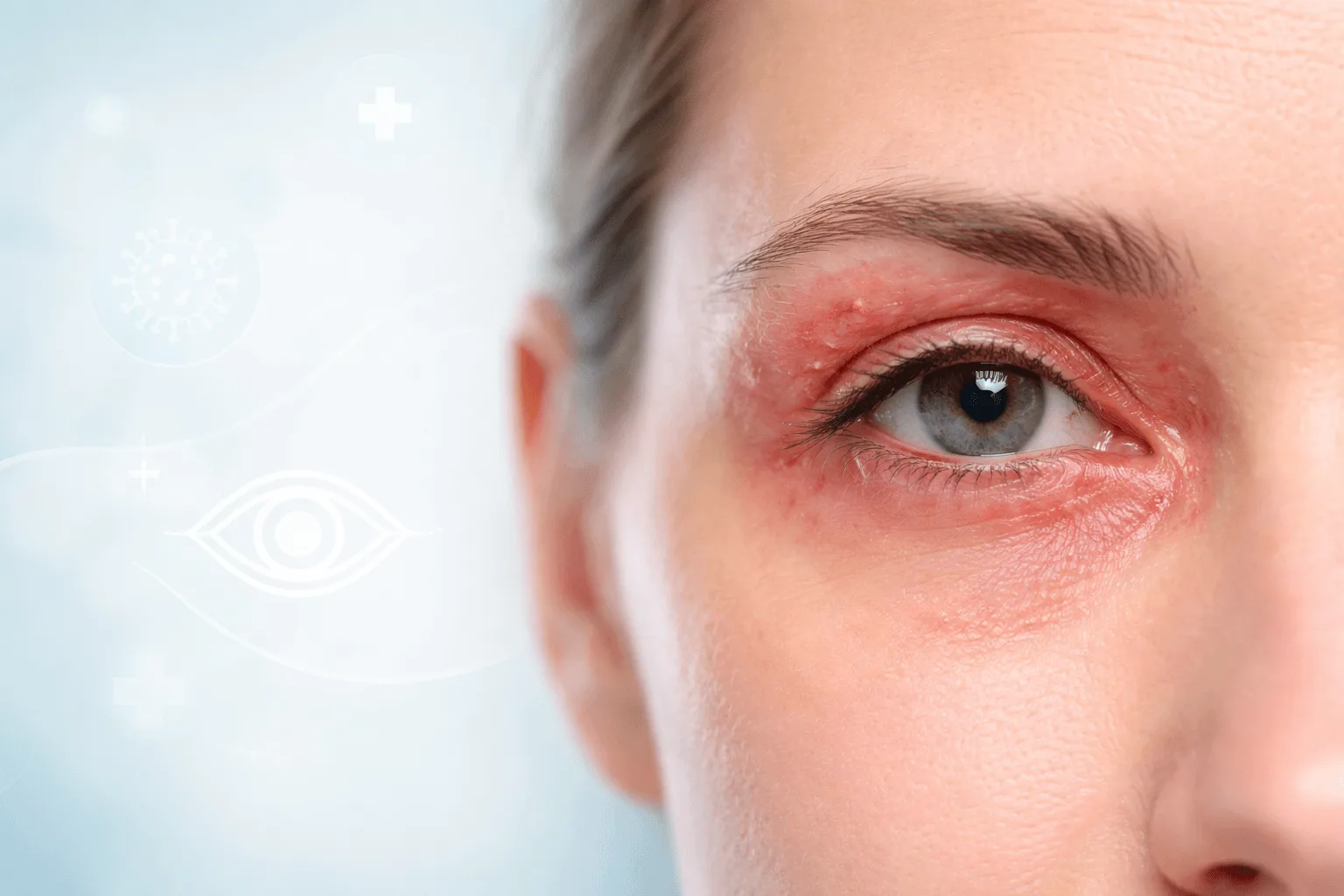 Shingles Damage on Eyes
