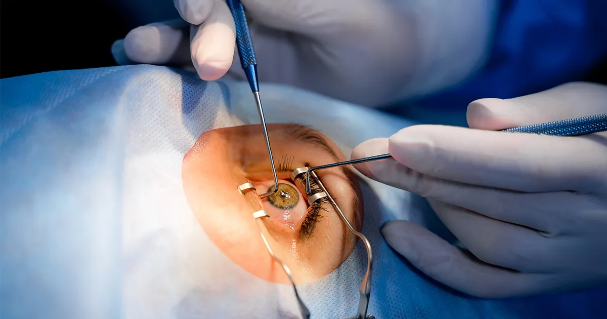 Who Needs Cataract Surgery_ Early Signs and Diagnosis