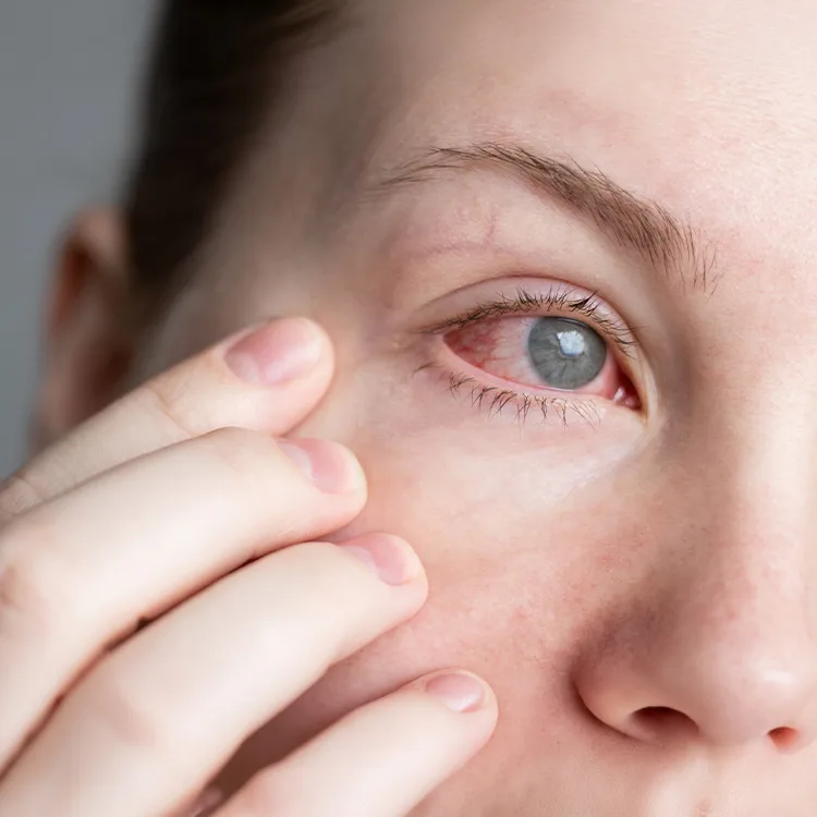 Angle Recession Glaucoma