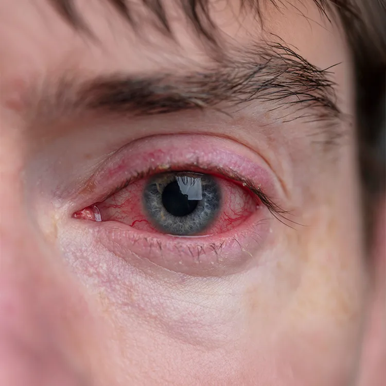 Blepharitis