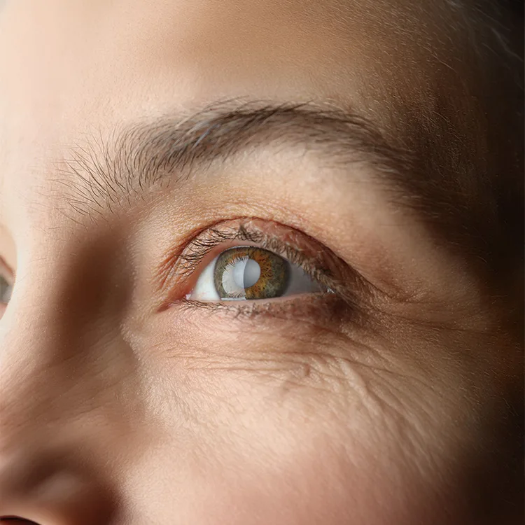 Closed Angle Glaucoma