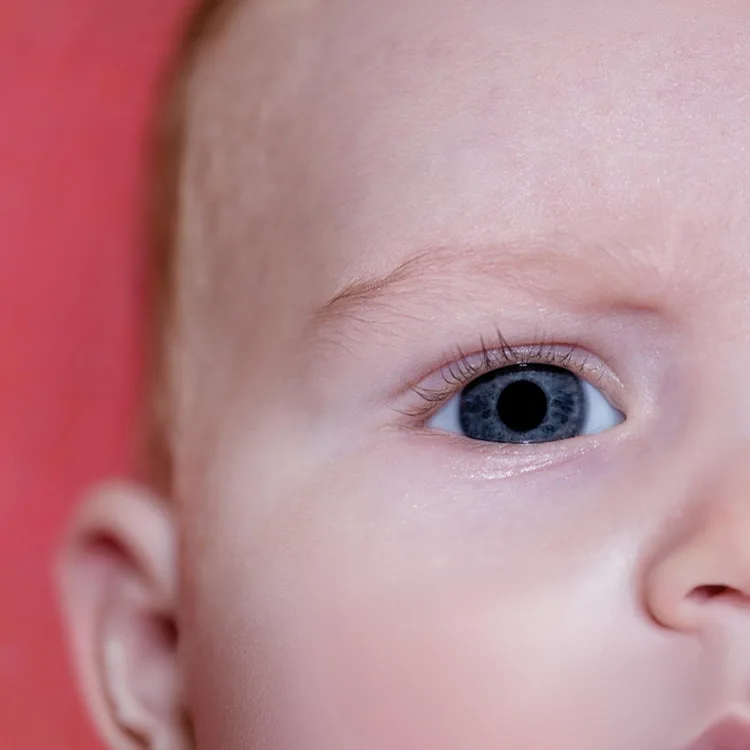 Congenital Cataract