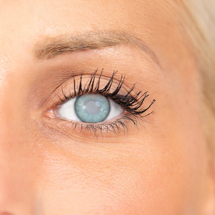 Cortical Cataract