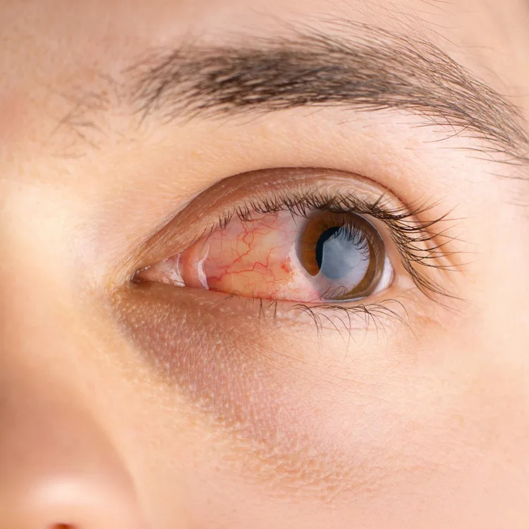 Fungal Keratitis