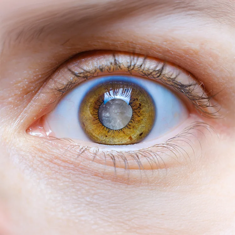 Glass Blowers Cataract