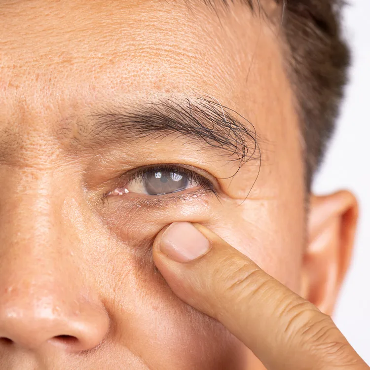 Hypermature Cataracts