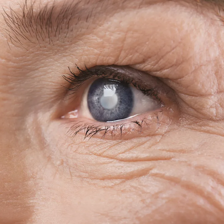 Lamellar Cataract