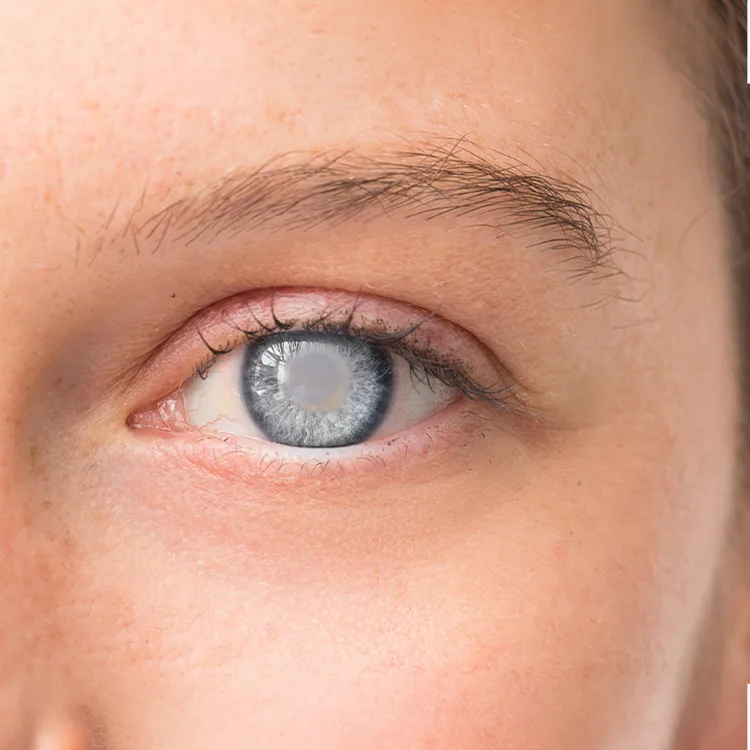 Morgagnian Cataract