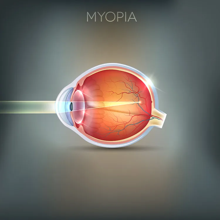 Myopia