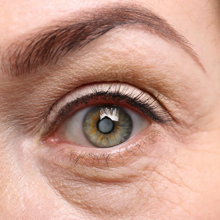 Senile Cataract