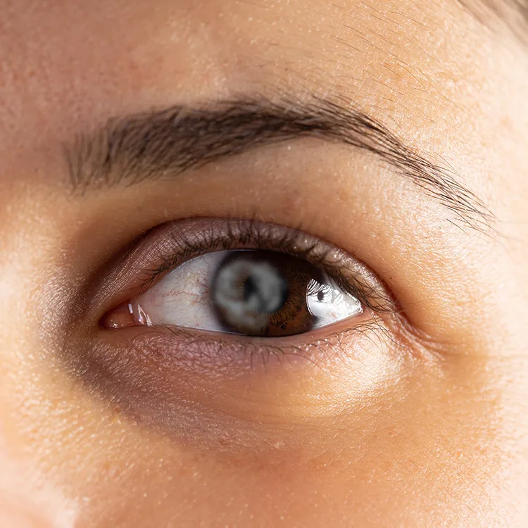 Snowflake Cataract