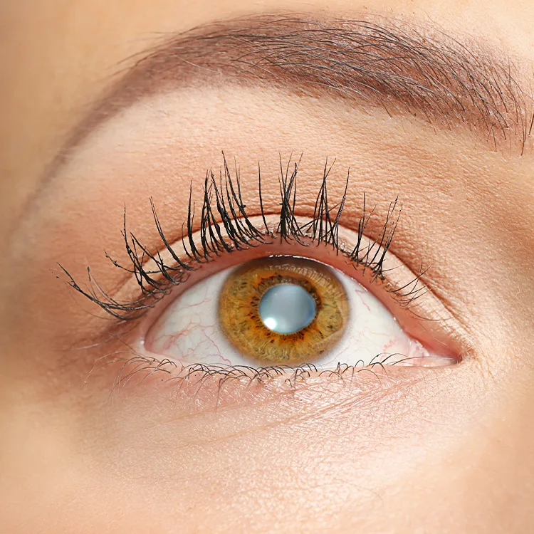 Sutural Cataract