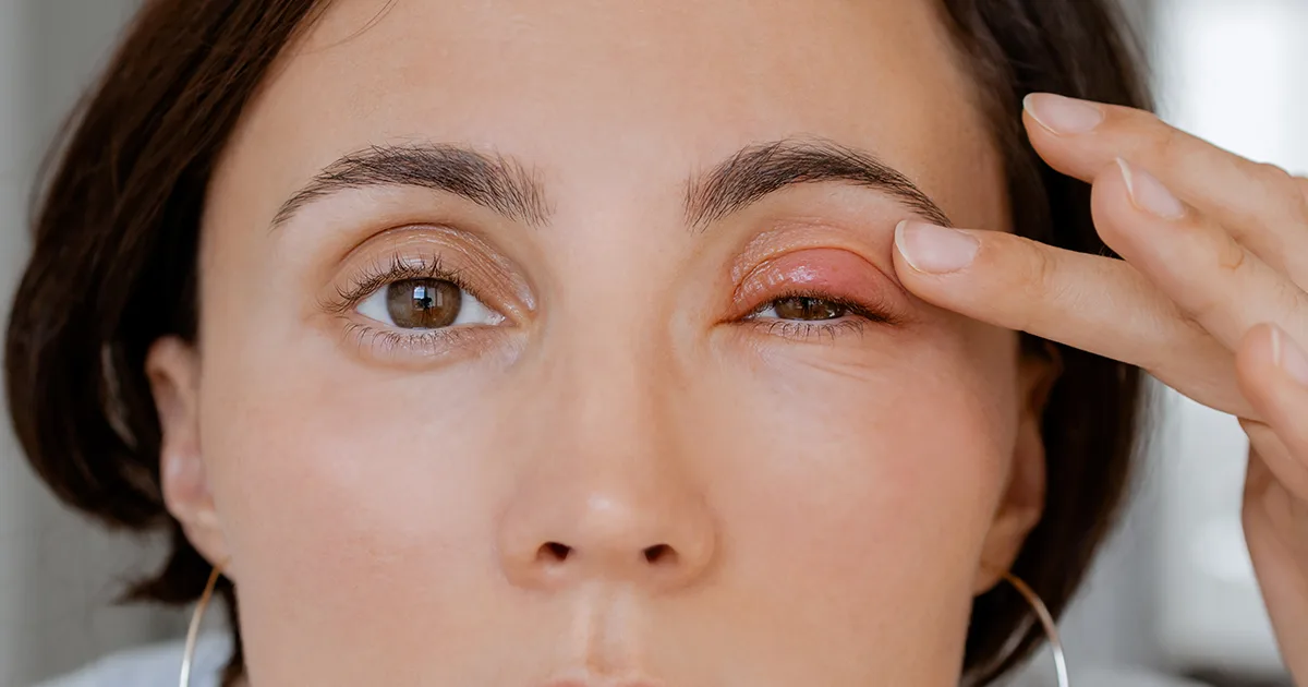 Chalazion vs stye comparison