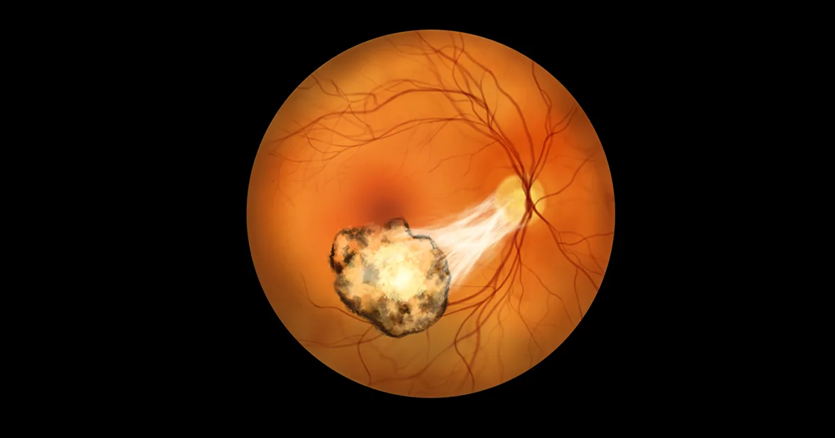 Choroiditis eye inflammation symptoms