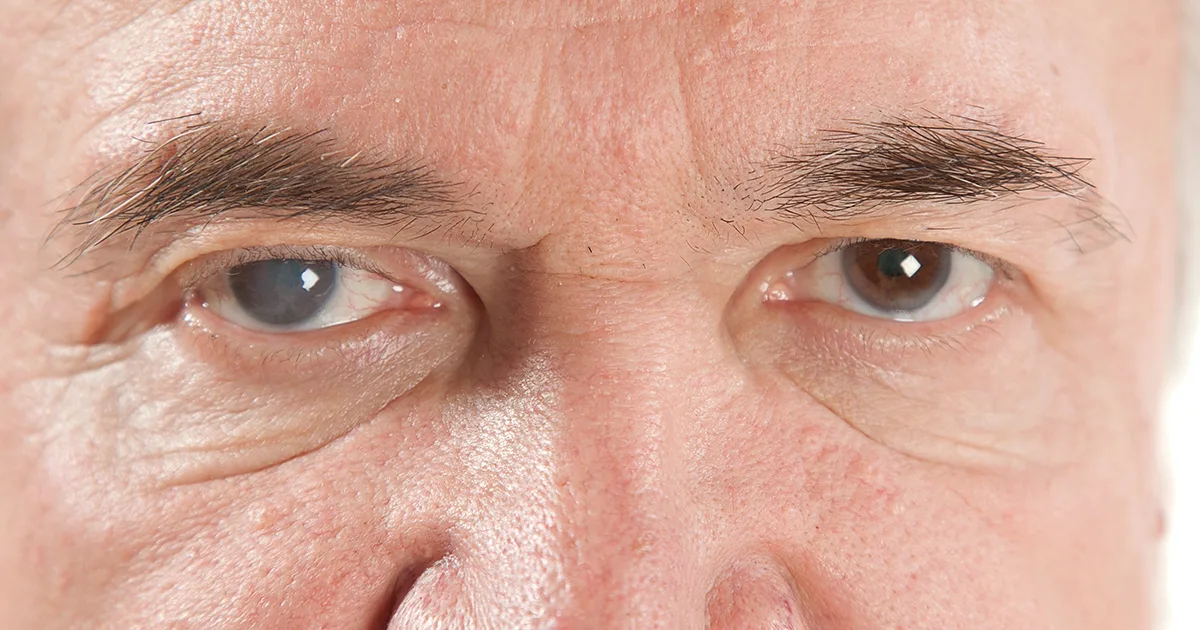 Diabetic retinopathy ICD-10 codes