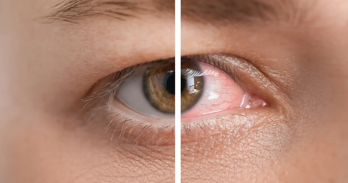 Cure dry eyes permanently