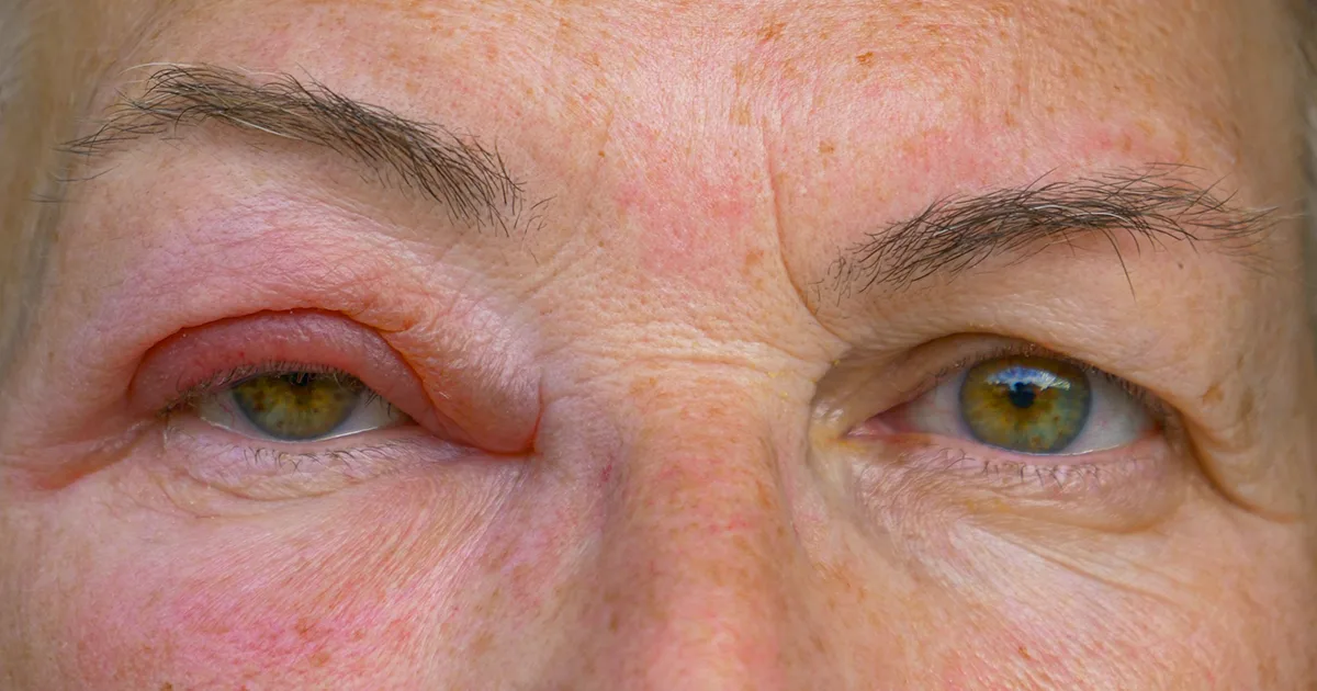 Swollen eyes puffy eyelids