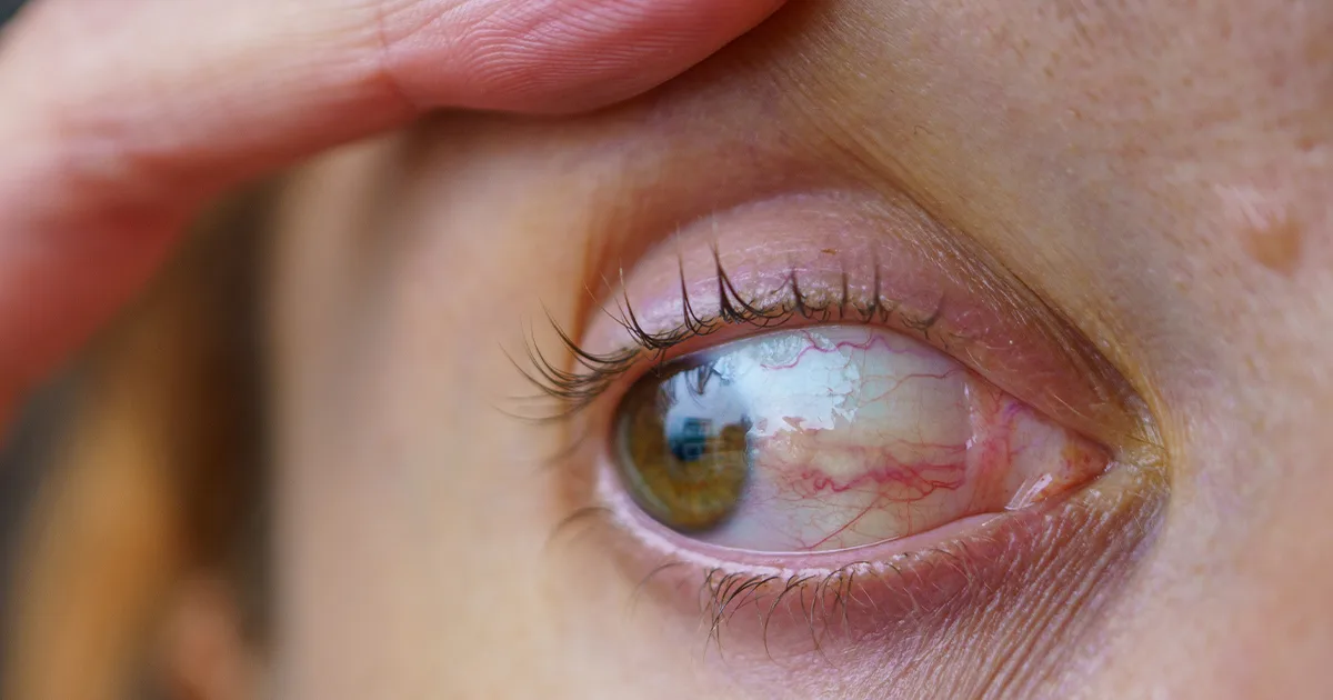 Pinguecula eye growth condition