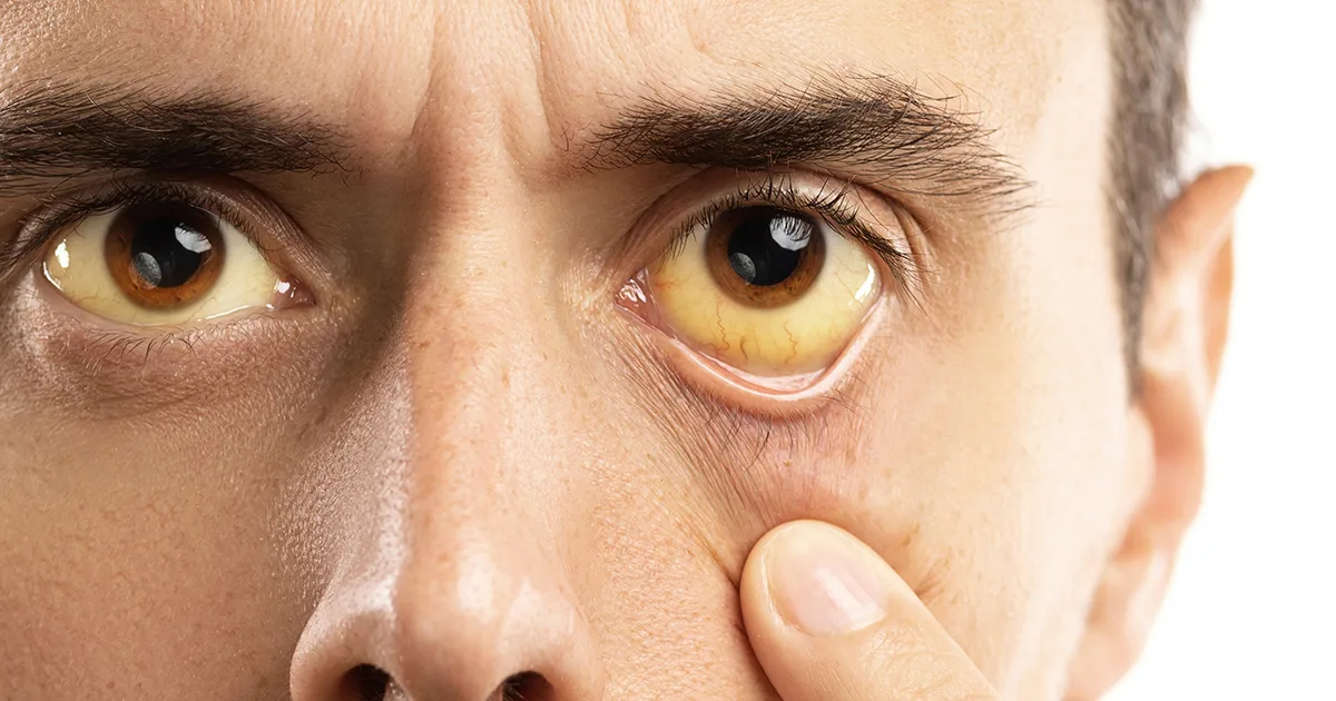 Scleral icterus yellow eyes