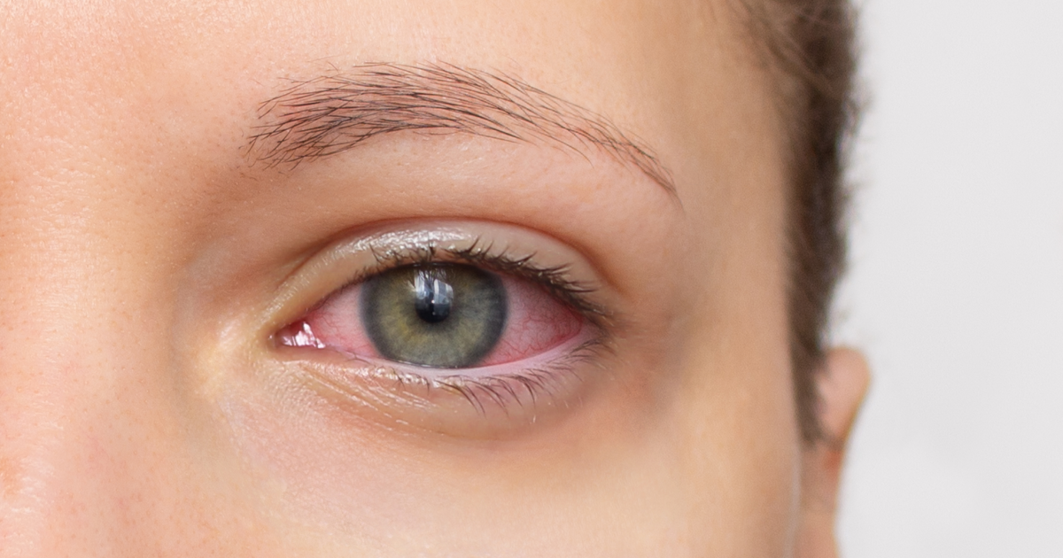 corneal abrasion