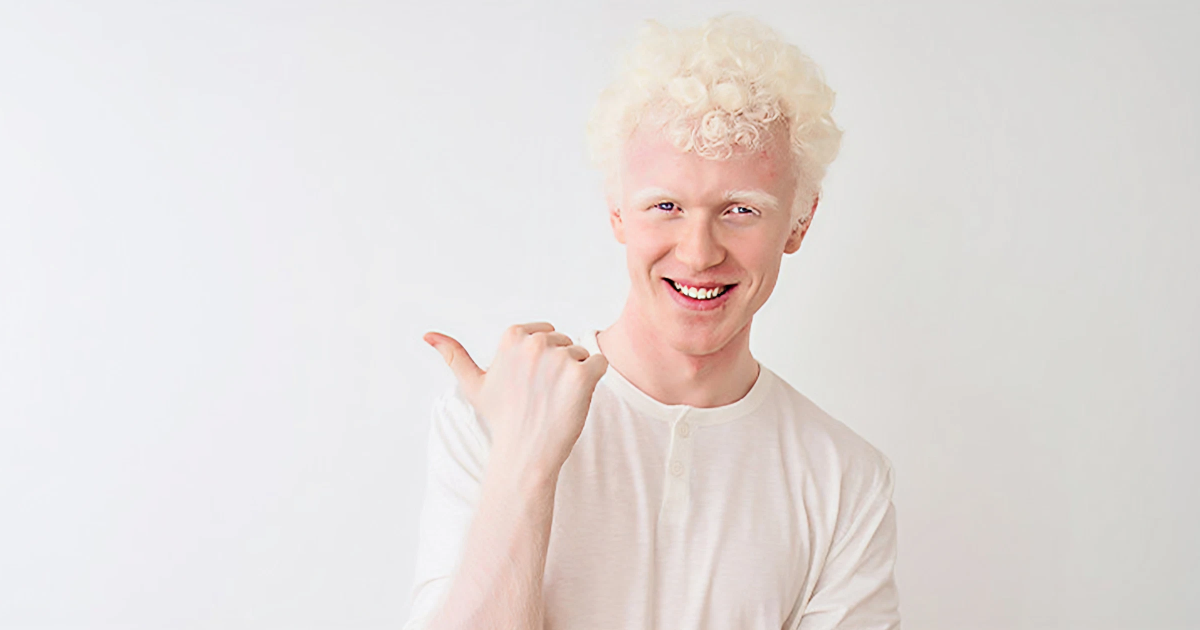albinism disease treatment​