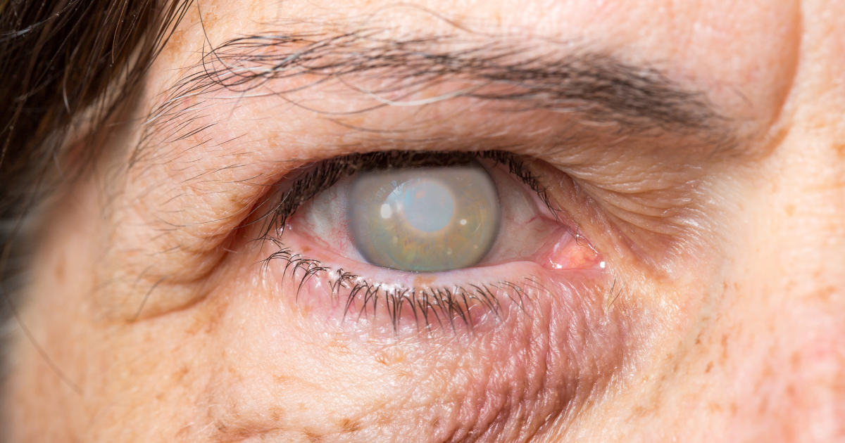 thyroid eye disease signs​