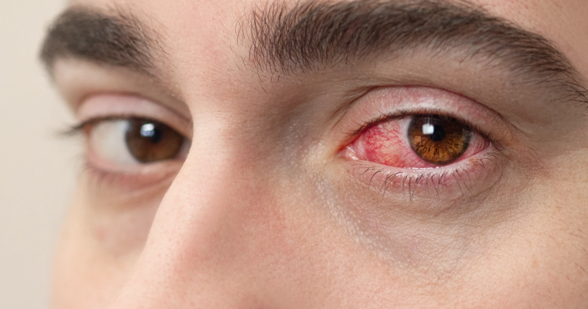 vernal conjunctivitis treatment