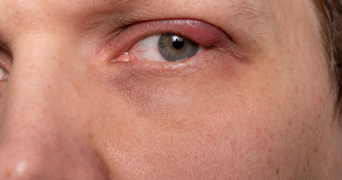 Eye affected by blepharitis