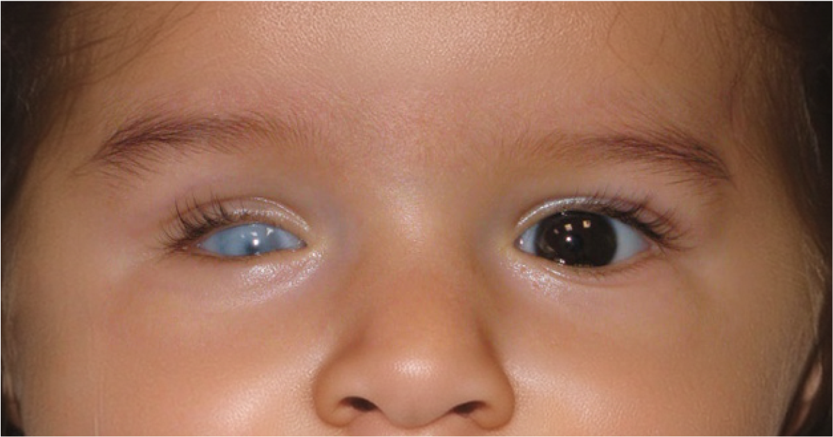 Microphthalmia in babies